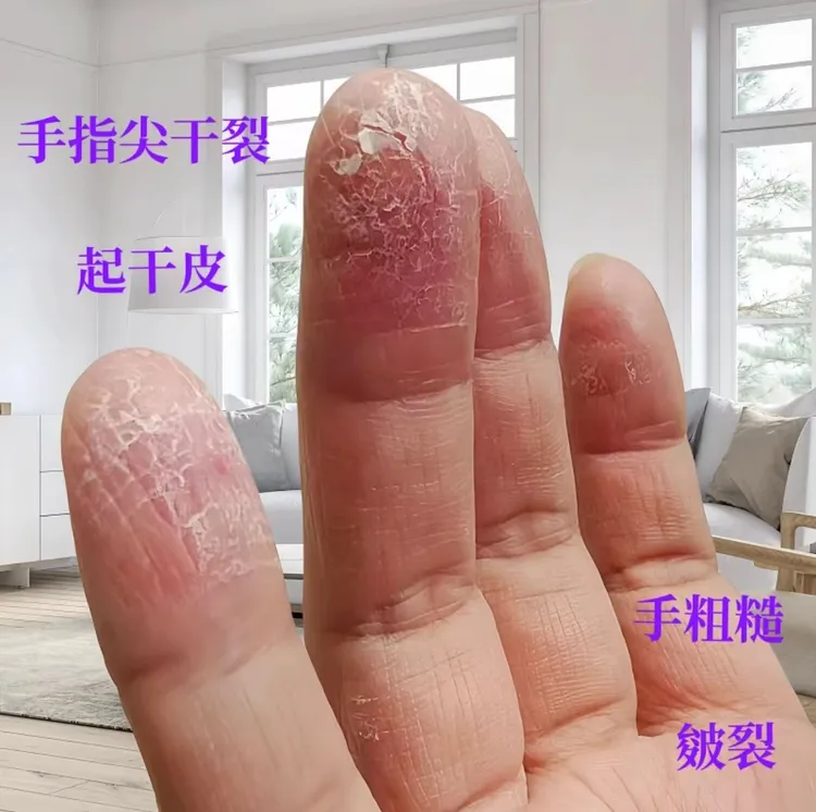 手脱皮手足脱皮膏手痒手脱皮皮肤起皮脱皮手脚脱皮抑菌软膏