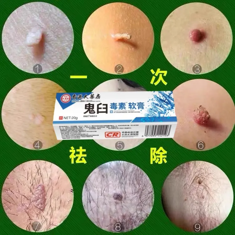 【小肉粒专用】鬼臼毒素软膏官方正品安全可靠药房同款外用涂抹软膏