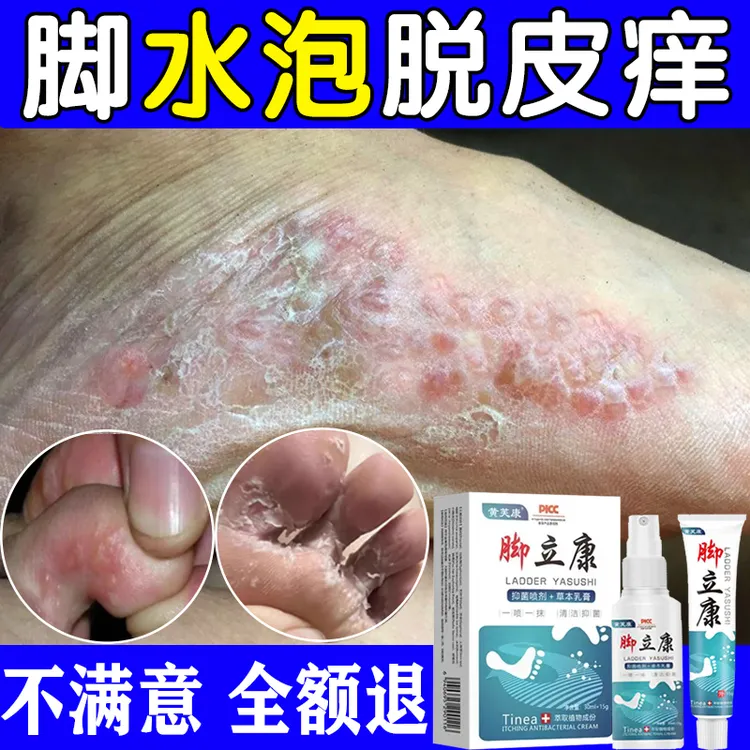 脚底脚上起小水痒泡又脱皮真菌王脚臭止痒抑菌软膏特效神器克星