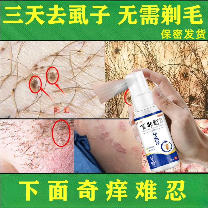 百部酊去虱子喷雾成人男女私处通用阴虱去除简单的办法