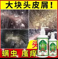 毛炎宁毛囊专用洗发水煤焦油洗剂头皮头部长红疙瘩痘痘去屑止痒
