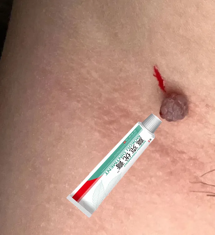 【无痕去脸上】正品小痦子膏去扁平肉刺去脖子丝状肉条小疙瘩去黑点