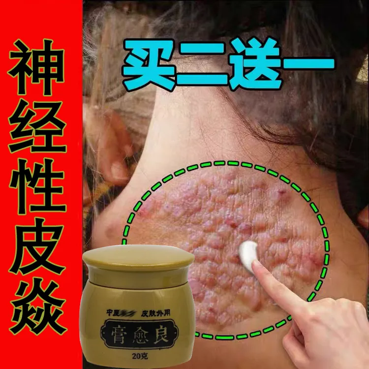 【膏愈良】神经性皮肤止痒膏顽固皮手足湿痒抑菌乳膏特效草本修复