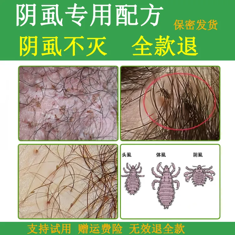 百部酊去虱喷雾男女成人阴用虱子虱卵一扫光阴虱专用喷雾头虱专用