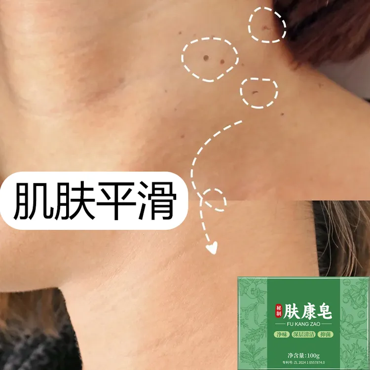 云医生秘制肤康皂手工快速改善脖子额头身上长肉粒无痛脱落