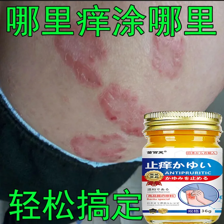 【主播亲测】顽固牛皮头藓银屑膏手足股止痒大腿内侧痒全身可用