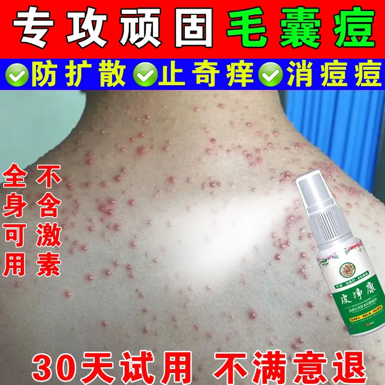 后背毛囊痘痘背上胸前脖子头皮红痘止痒专用软膏皮肤抑菌喷剂神器