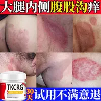 大腿内侧真菌止痒膏男下大腿体痒腹股沟痒特效止痒草本舒缓正品