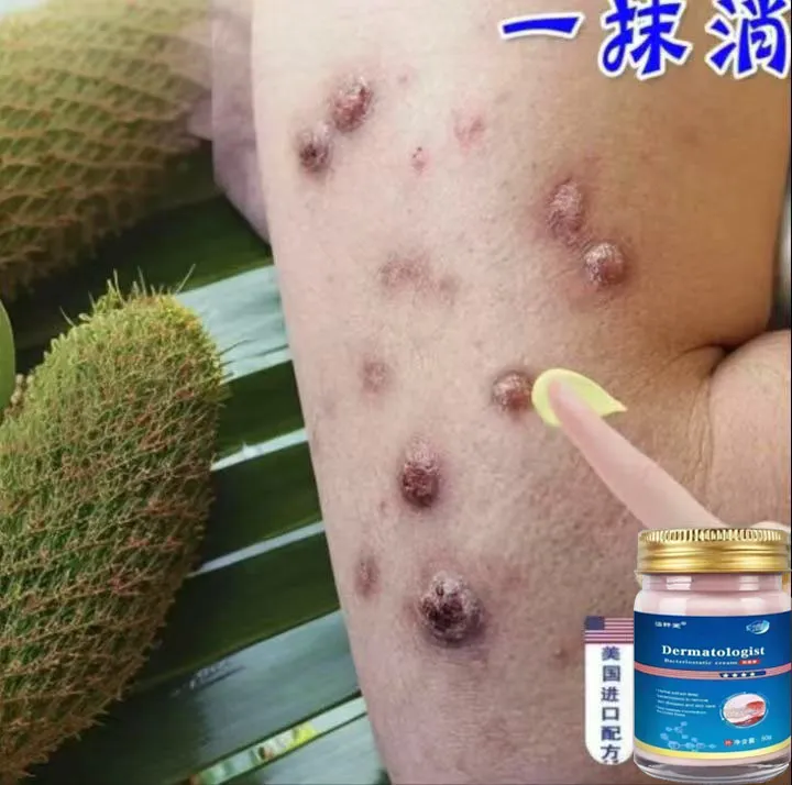 结节性痒疹专用膏痘痘皮肤瘙痒止痒膏后背痒疙瘩草本抑菌外用乳膏