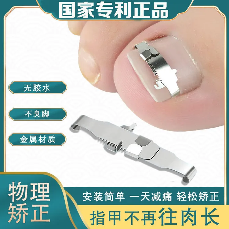 正甲扣甲沟炎矫正神器嵌甲专用指甲矫正器脚趾甲往肉里长纠正扎肉
