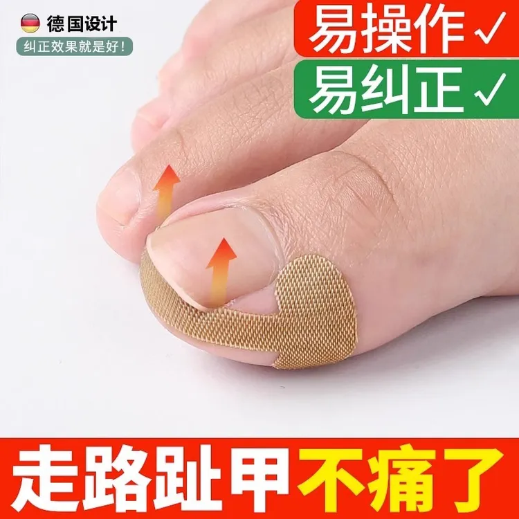 正甲贴甲沟炎矫正神器嵌甲专用指甲矫正器脚趾甲扎肉往肉里长垫片