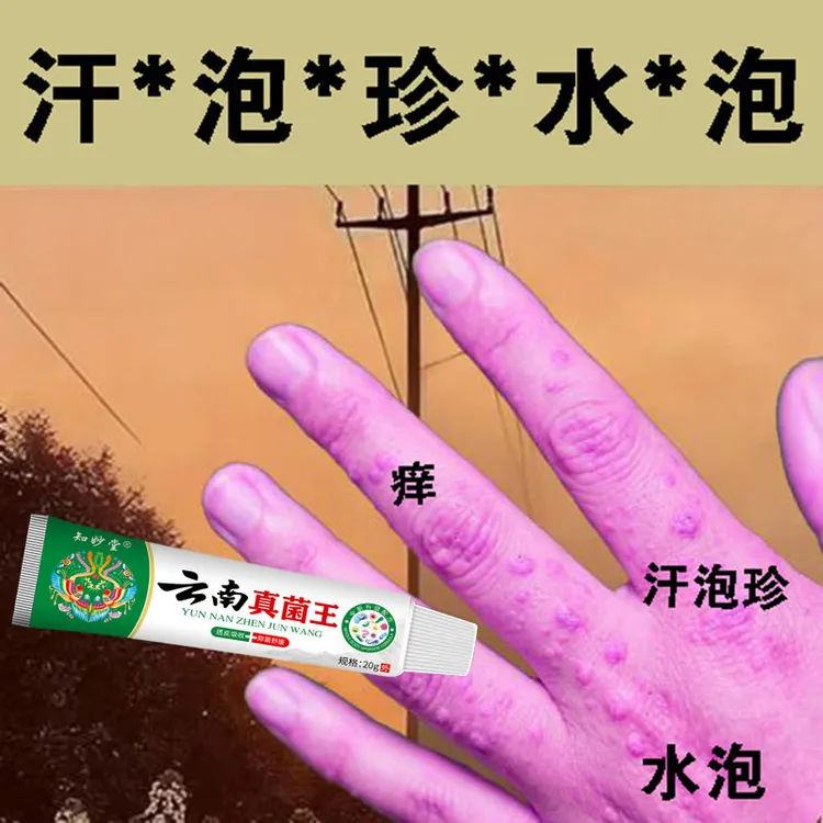 手上起小水泡止痒膏脱皮抑菌克星手指缝痒干裂汗珍泡专用乳膏