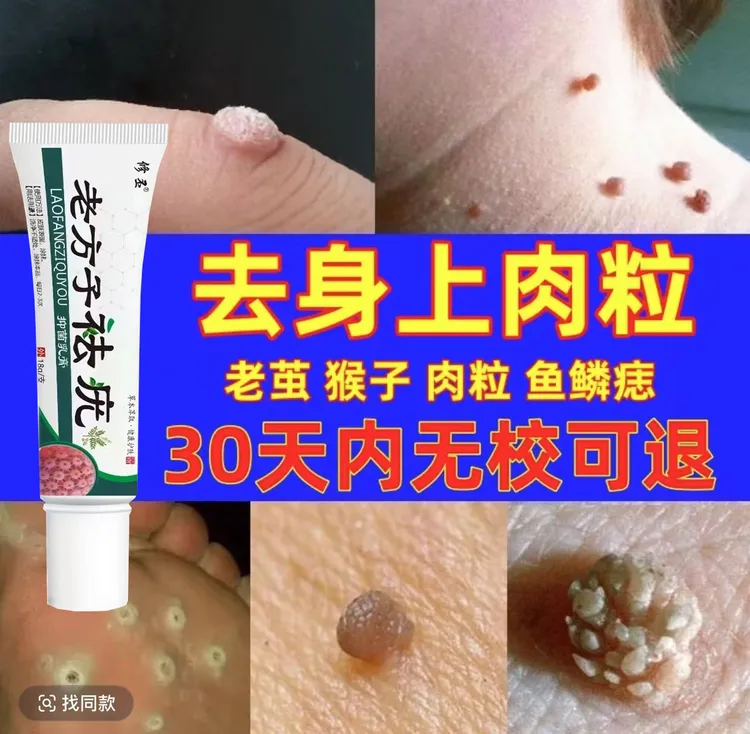 【小肉粒专用】老方子克尤膏脖子手足腋下丝状扁平肉刺