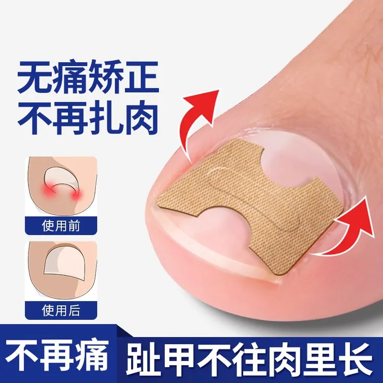 正甲贴甲沟炎矫正神器指甲扎肉嵌甲矫正器脚趾甲往肉里长纠正垫片