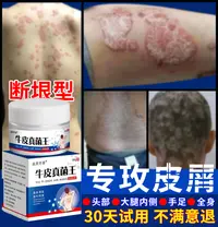 【垠屑王】牛用皮肤头蘚膏顽固手足股红点止痒大腿内侧全身用真菌王