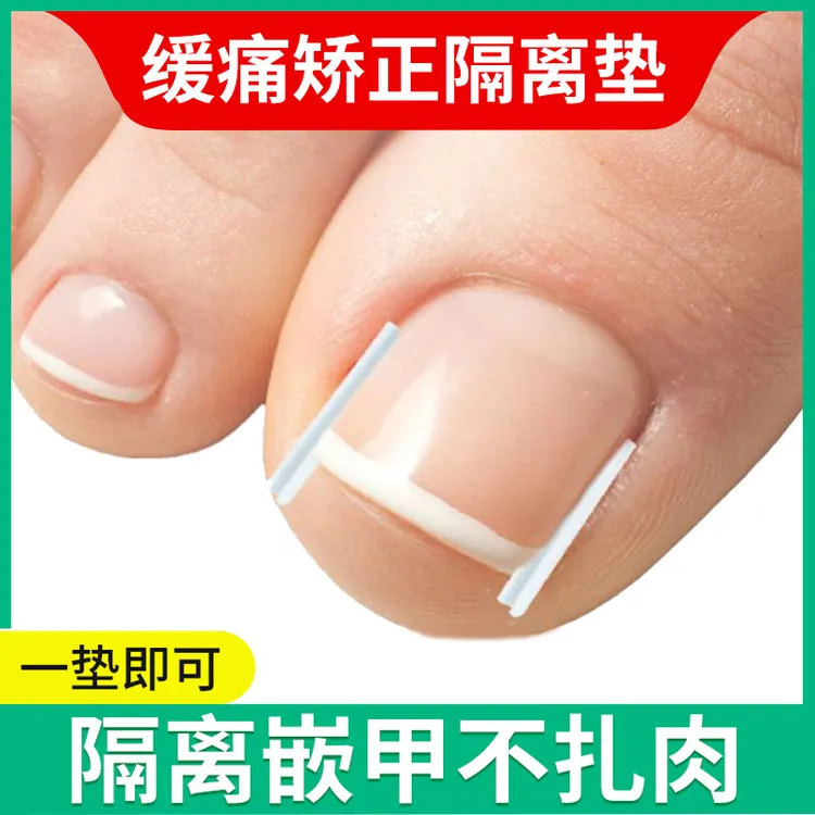 甲沟矫正器填充垫片炎嵌甲神器防脚指甲往肉里长专用正甲工具贴片