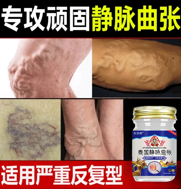 静-脉-曲张蚯蚓-腿专用黑红-血-丝止痒身体护理草本祛湿外用膏