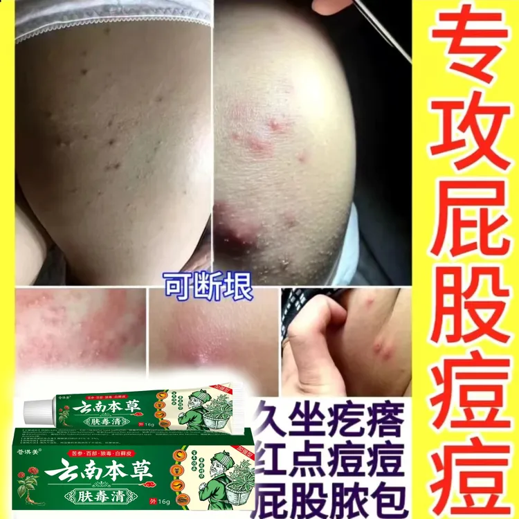 屁股上长痘痘湿痒脓包疙瘩特效久快速消除坐痤祛痘止痒膏