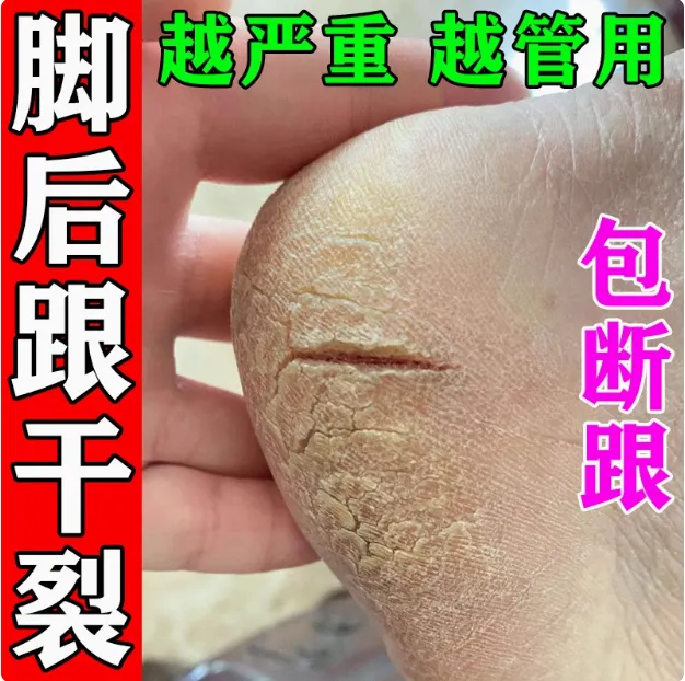 脚后跟起皮粗糙干裂起硬皮修护脚底板脱皮干裂起硬皮修复膏防裂