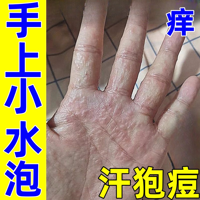 手上汗疱痘小水泡手掌起水泡手痒手心起水泡干痒脱皮开裂专用软膏