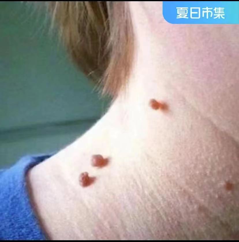 华佗【拍一发二】小肉粒肉圪疙瘩正品手工制作草本修护外用盒装