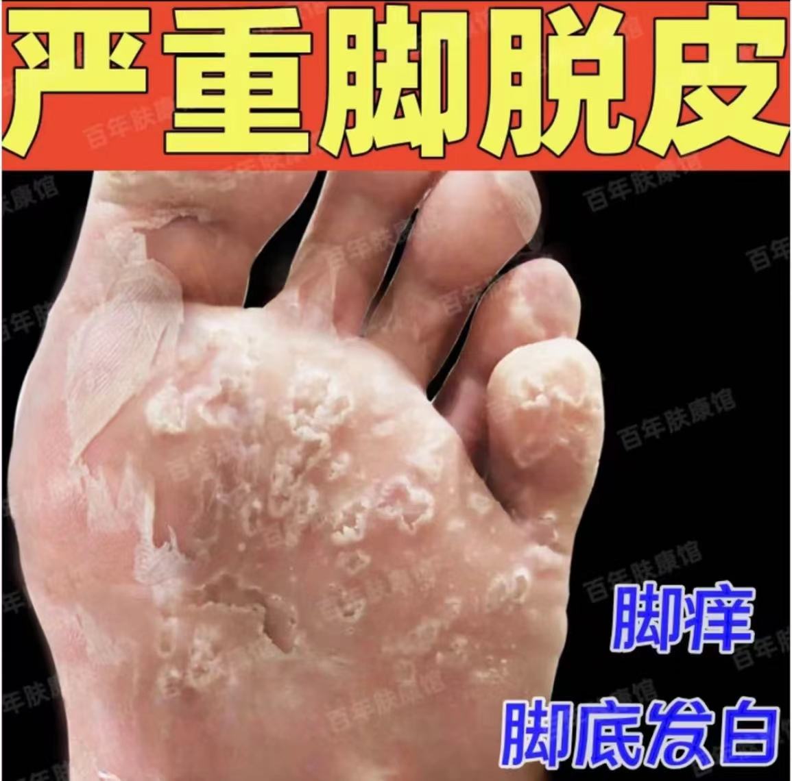 脚掌脱皮严重大拇脚趾脱皮脚底脚心掉皮脚皮肤粗糙干燥抑菌软膏