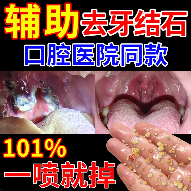牙结石去除器速溶解除牙结石非速效漱口水洗牙齿污垢牙垢牙黄清