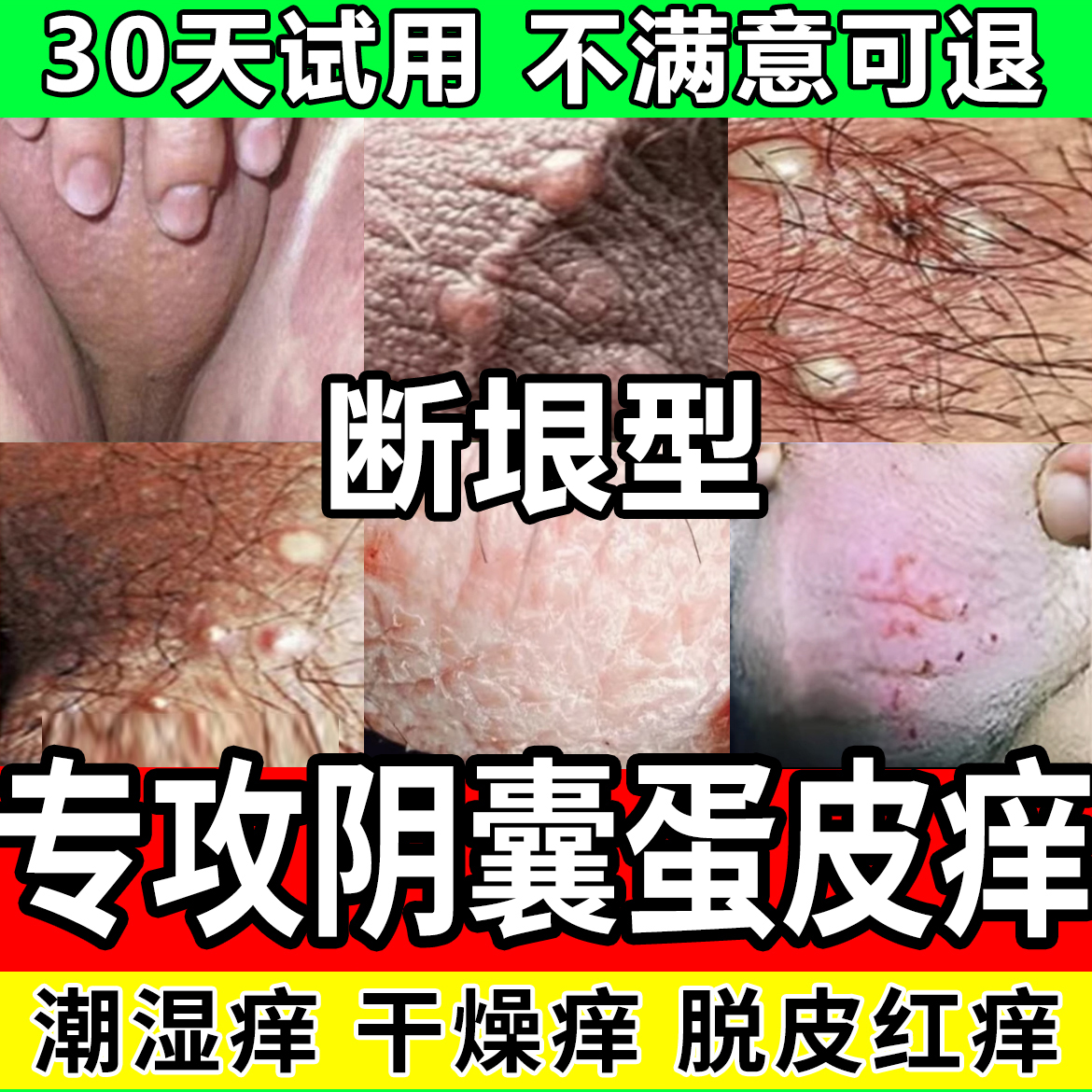 男人私处下体蛋蛋痒大腿内侧阴囊起乌龟皮疙瘩真菌王瘙痒止痒膏