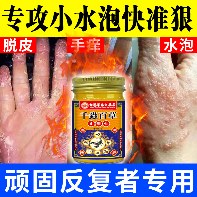 【官方正品】汗泡珍手上长小水泡手指缝脱皮开裂奇痒抑菌软膏真菌王