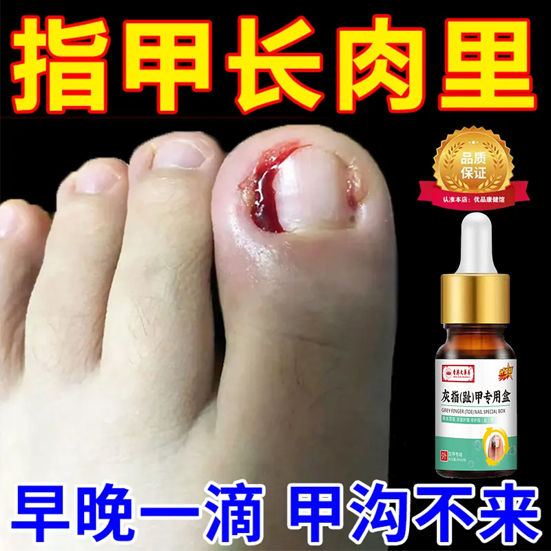 指甲长肉里甲沟肿大有脓包软甲脱甲脚指甲化脓脚趾头专用甲沟液