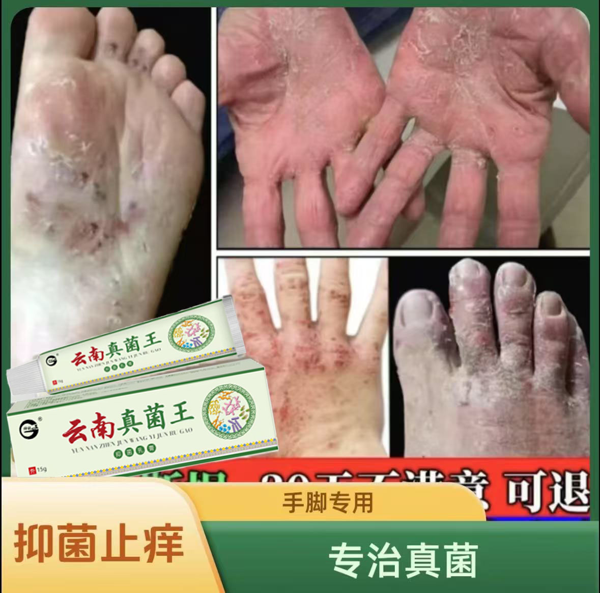 脚底脚上起小水泡又痒又脱皮脚臭气止痒真菌感染草本抑菌克星神器