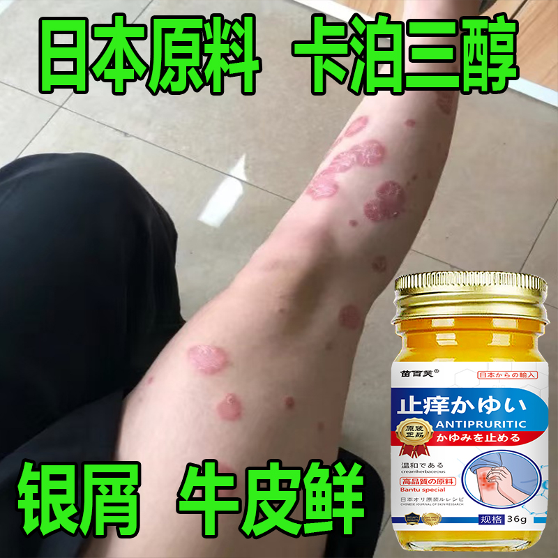 牛皮专用银屑顽鲜卡泊三淳倍他米软膏手足体股头鲜全身草本止痒膏