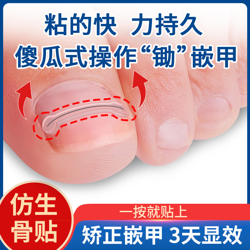 钢丝嵌甲矫正贴片记忆金属甲沟矫正器炎正甲贴趾甲贴片指甲长肉里