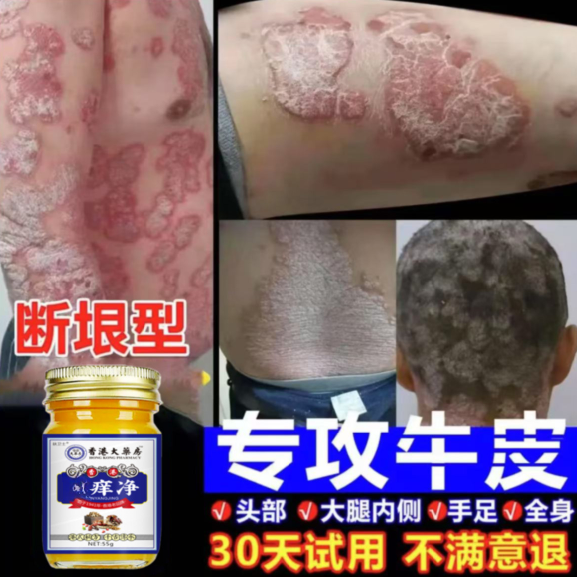 【香港廯痒净】牛皮廯肤顽固手足体股廯红点止痒大腿内侧痒外用乳膏