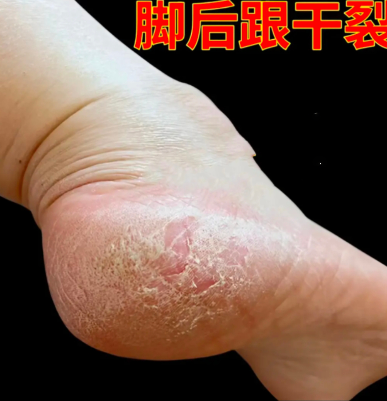 脚后跟干裂粗糙脚底起皮脚痒脚后跟脱皮脚臭抑菌止痒软膏