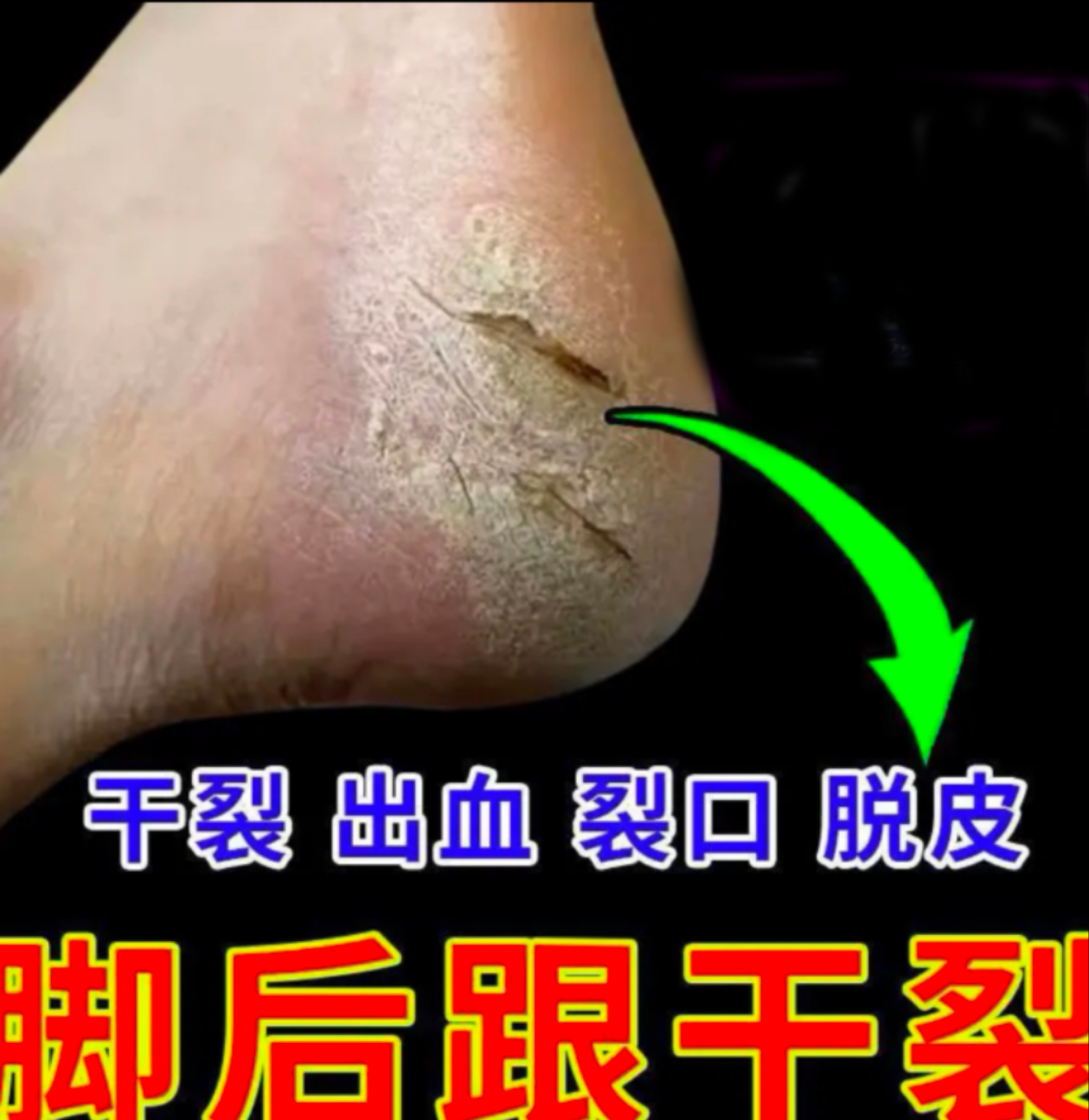 脚后跟干裂乳膏手脚开裂裂口脱皮修复霜皲裂手足龟裂足裂起皮乳膏
