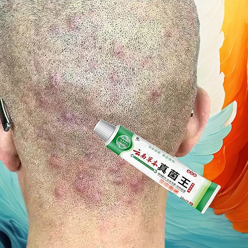 头皮毛囊头上长小红疙瘩脓包头屑痘痘头部专用止痒克星外用膏