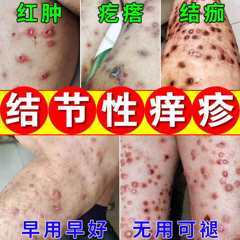节性痒疹特效治顽固硬疙瘩全身皮肤瘙痒红疹硬块止痒抑菌专用膏